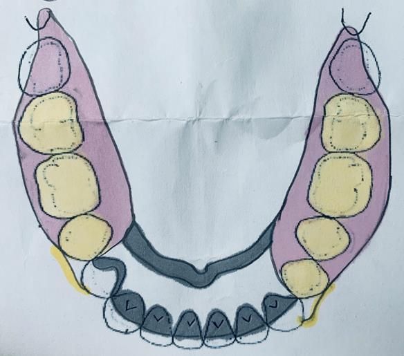Figure 64 Design of metal based lower denture