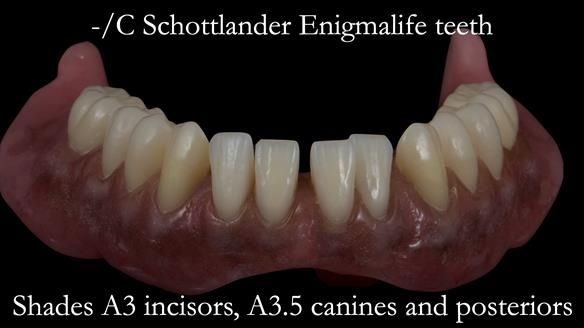 Newsletter 53 showing the making and fitting of ultra life-like dentures for Valena