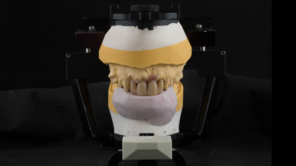 Figure 25 UR21 UL2 teeth removed from cast and UR21 UL12 teeth arranged to pre-drifted positions