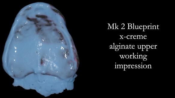 Replacing Madeline’s Complete denture FULL PROTOCOL