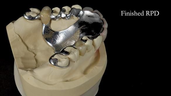 Newsletter 81 - Pam’s Story — how a partial denture changed her life (+ live walkthrough this Thursday)