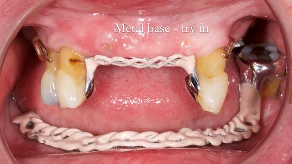 Finlay's Newsletter 59 Ultra hard partial dentures made for Gill