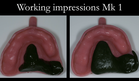 Figure 16 Custom trays for the definitive impressions. Greenstick added to create a stop on the palate to avoid the tray touching the teeth. Border moulded in the UL area.