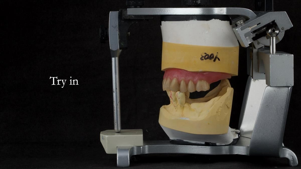 Newsletter 87 – Father Peter: A Partial Denture that needed Minor Miracle