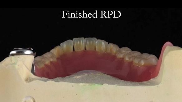 Finlay's Newsletter 59 Ultra hard partial dentures made for Gill