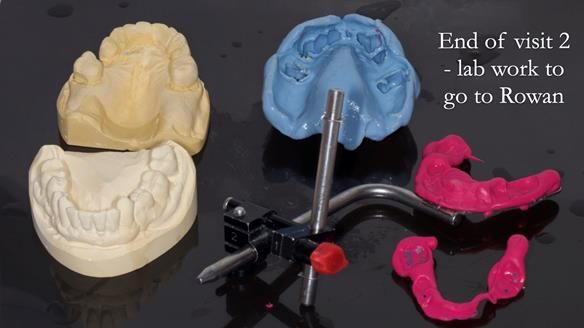 Newsletter 77: Jeremy’s case – immediate complete upper denture