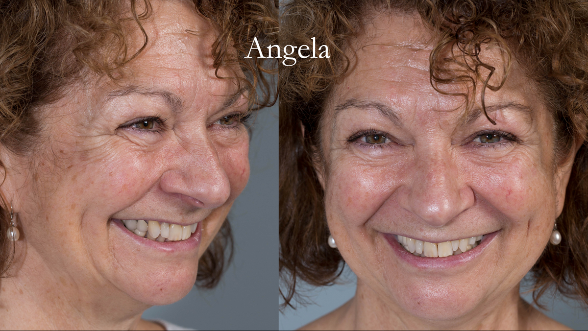 Figure 1 Pre - treatment.