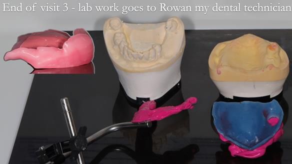 Finlay's Newsletter 58 Gasket upper partial denture for Zoe