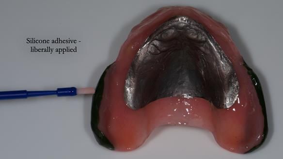 Newsletter 77: Jeremy’s case – immediate complete upper denture