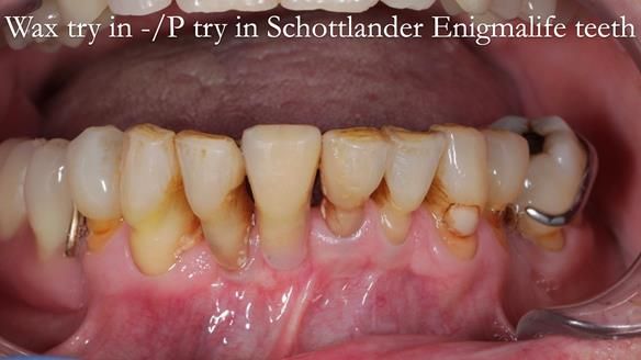 Newsletter 54 case presentation upper complete denture and lower Scandinavian designed hygienic partial denture for David