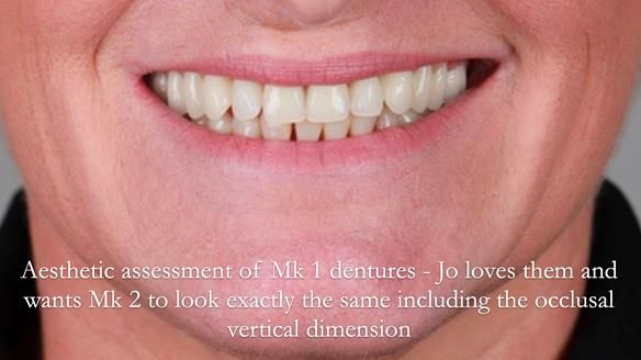 Newsletter 52 Managing Jo’s failing dentition with extractions and Mk 1/Mk 2 complete upper dentures and lower partial dentures FULL PROTOCOL