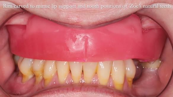 Finlay's Newsletter 58 Gasket upper partial denture for Zoe