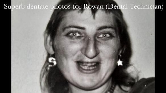 Newsletter 55 Provision of metal based partial dentures for Zephyrine with a repaired cleft lip and palate