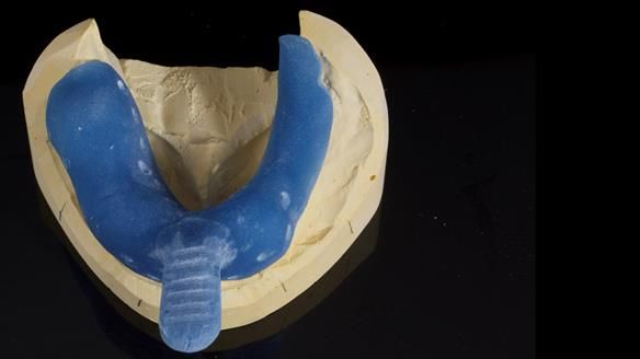 Newsletter 86 Peter the Architect — precision removable partial dentures case study