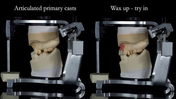 Newsletter 81 - Pam’s Story — how a partial denture changed her life (+ live walkthrough this Thursday)