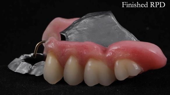 Finlay's Newsletter 60 Sylvia's upper Kennedy Class 2 Mod 1 metal based upper RPD