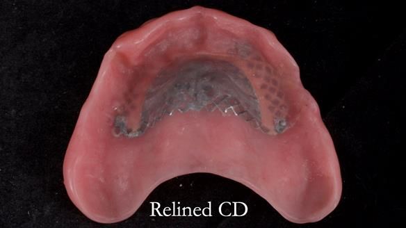Finlay's Newsletter 62 provision of extractions and metal based complete dentures for Rafique