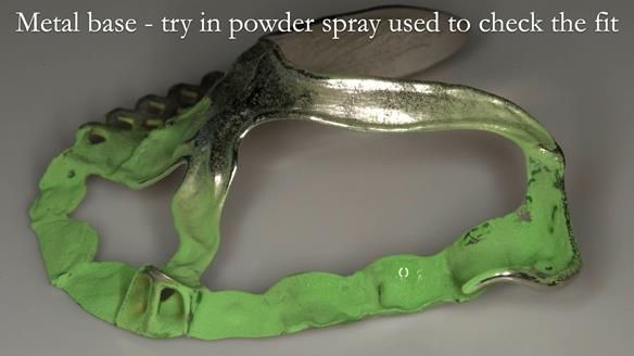 Newsletter 51 Managing Anne’s failing dentition with distal extension base RPD/Splint FULL PROTOCOL