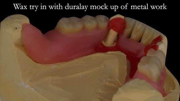 Finlay's Case Study Newsletter 40 - Immediate Mk 1 RPD to Definitive Mk 2 RPD - full protocol