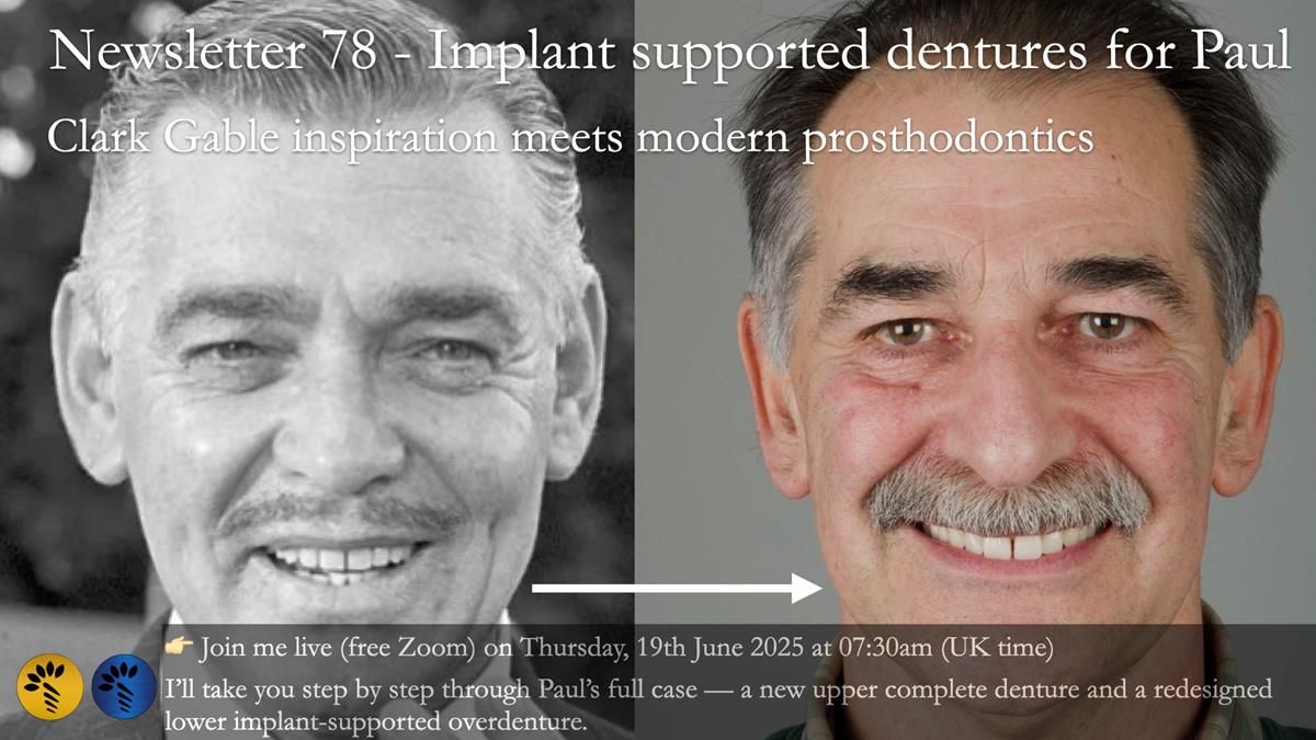 Newsletter 78: What do Clark Gable and a Locator® overdenture have in common?