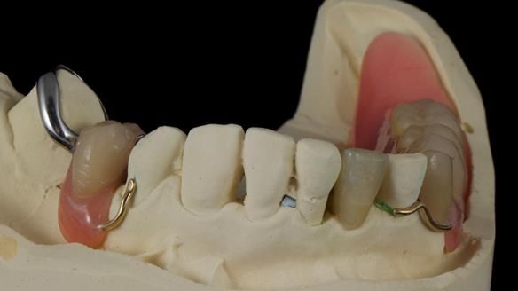 Newsletter 55 Provision of metal based partial dentures for Zephyrine with a repaired cleft lip and palate
