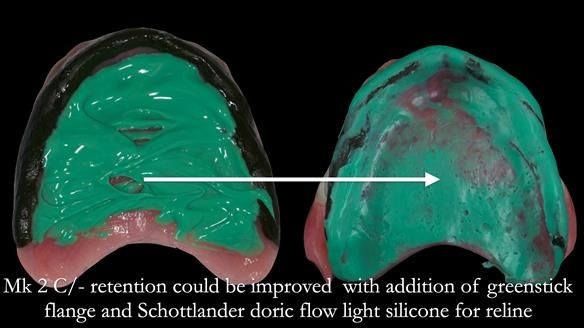 Replacing Madeline’s Complete denture FULL PROTOCOL
