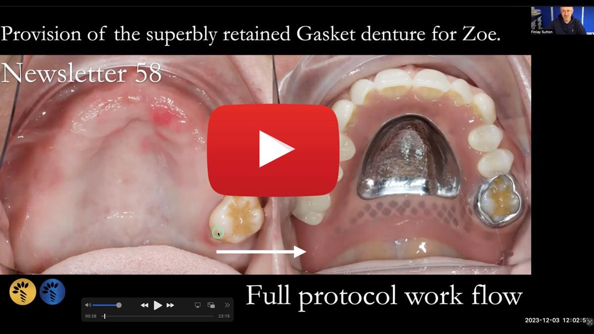 Finlay's Newsletter 58 Gasket upper partial denture for Zoe