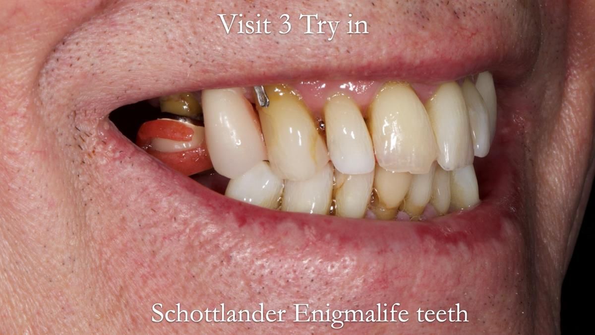 Newsletter 89 – Simon: A Challenging Kennedy Class II Division 1 Upper CoCr Partial Denture with a High Smile Line