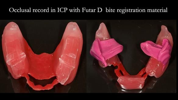 Finlay's Case Study Newsletter 40 - Immediate Mk 1 RPD to Definitive Mk 2 RPD - full protocol