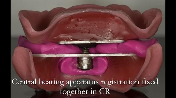 Newsletter 75: Marion’s case - Step-by-step complete denture workflow