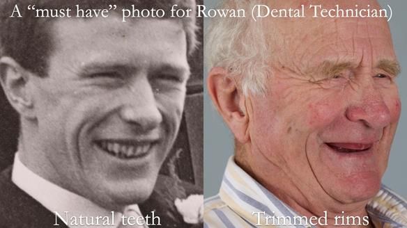 Complete denture Class II div 2 deep overbite Newsletter 39