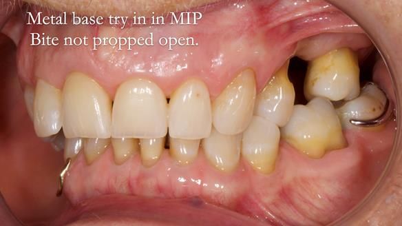 Finlay's Newsletter 61 provision of a lower unilateral free end saddle metal based partial denture for Joyce