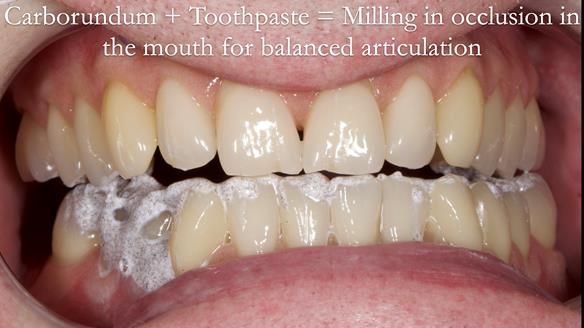 Newsletter 57 showcases the making and fitting process of implant-supported complete dentures for Alisdair