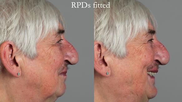 Newsletter 55 Provision of metal based partial dentures for Zephyrine with a repaired cleft lip and palate