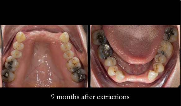 Figure 76 Ridges 9 months after extractions