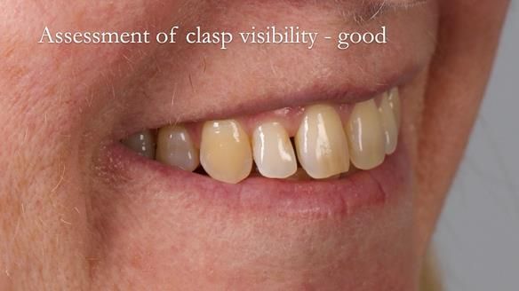 Solving Sue's failed implants with metal based RPD - full protocol Newsletter 43