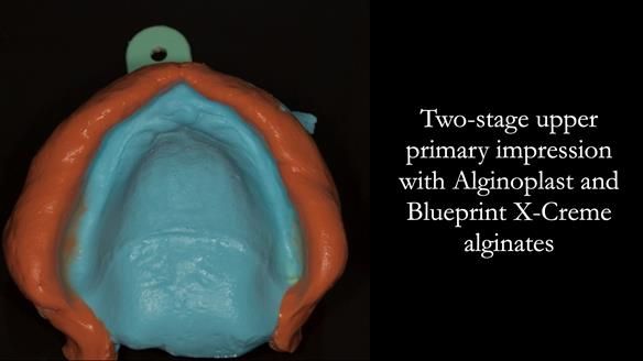 Newsletter 75: Marion’s case - Step-by-step complete denture workflow
