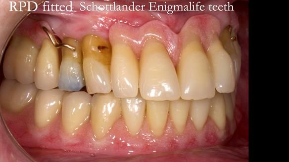 Finlay's Newsletter 59 Ultra hard partial dentures made for Gill