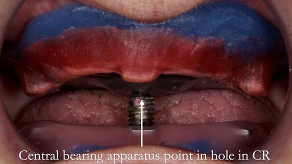 Newsletter 83: Sheila’s Complete Denture Success