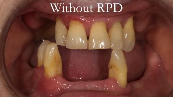 Finlay's Case Study Newsletter 40 - Immediate Mk 1 RPD to Definitive Mk 2 RPD - full protocol