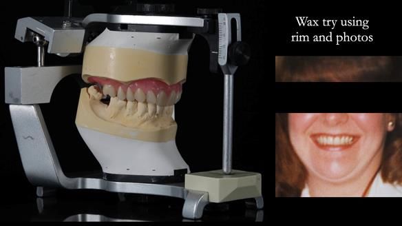 Finlay's Newsletter 58 Gasket upper partial denture for Zoe