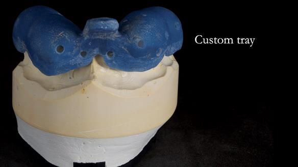 Newsletter 81 - Pam’s Story — how a partial denture changed her life (+ live walkthrough this Thursday)