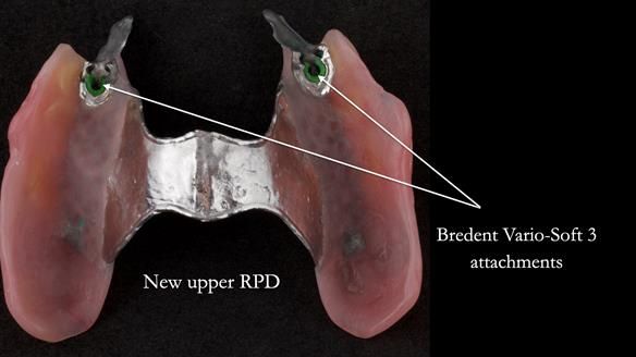 Newsletter 76: Jackie’s case – Telescopic overdenture & precision RPD (the tricky truth!)