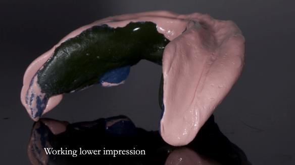 Newsletter 83: Sheila’s Complete Denture Success