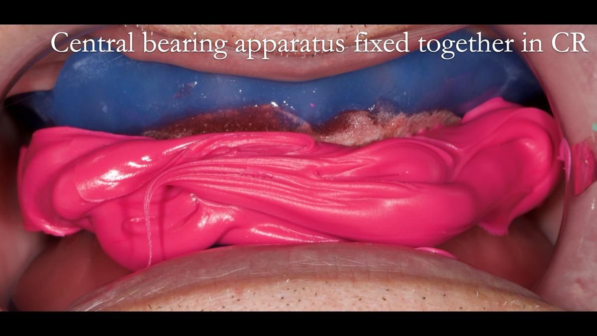 Fin’s Newsletter 88 — Complete dentures - full protocol… he rearranged his own teeth!