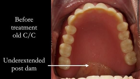 Complete denture Class II div 2 deep overbite Newsletter 39
