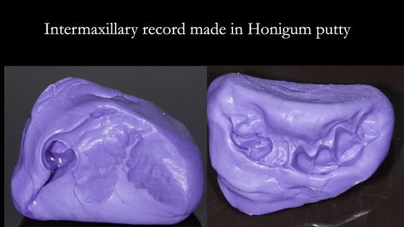 Newsletter 55 Provision of metal based partial dentures for Zephyrine with a repaired cleft lip and palate