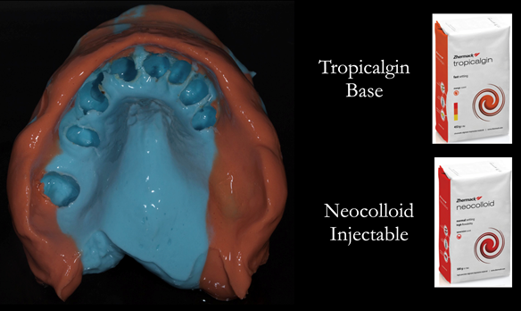 Figure 12 Upper primary impression made in two stages using Zhermack alginate. This allows full extension to record the sulcus