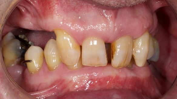 Newsletter 86 Peter the Architect — precision removable partial dentures case study