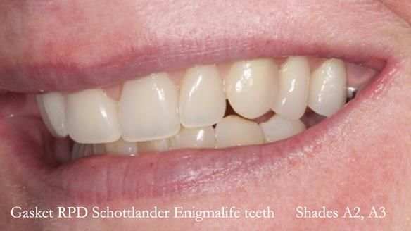 Finlay's Newsletter 58 Gasket upper partial denture for Zoe